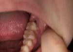 Снятие швов после удаления ретирированного зуба, дырка в десне фото 1