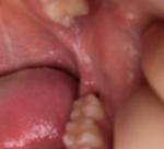 Снятие швов после удаления ретирированного зуба, дырка в десне фото 2