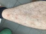 Красные пятна на голени ног, что это и как лечить? фото 1