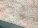 Красные пятна на голени ног, что это и как лечить? фото 3