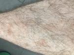 Красные пятна на голени ног, что это и как лечить? фото 4