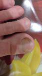 Изменение ногтя на большом пальце фото 2