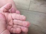 Ребёнку 3,3 года сходит кожа на пальцах рук и ног фото 1
