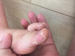 Ребёнку 3,3 года сходит кожа на пальцах рук и ног фото 2