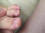 Ребёнку 3,3 года сходит кожа на пальцах рук и ног фото 3