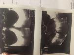 Фолликулярная киста правого яичника и новоринг фото 2