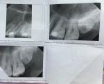 Болит зуб после удаления нерва фото 1