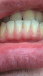 Образования на нижней десне между зубами фото 1