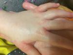 Сыпь между пальцев и на ладонях у ребёнка фото 4
