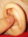 Ямочка в завитке ушной раковины фото 1