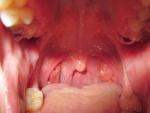 Хронический тонзиллит, боль в горле, воспаление миндалин фото 1