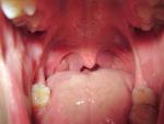 Хронический тонзиллит, боль в горле, воспаление миндалин фото 3
