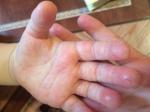 Шелушение пальцев после аллергии фото 1