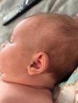 Акне новорождённого или аллергия? фото 2