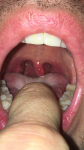 Опух язычок в горле фото 1