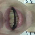 Искривление зуба фото 1