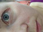 Дерматит в области носогубного треугольника и уголков глаз фото 3