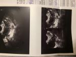 Филликулярная киста и планирование беременности фото 2