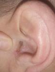 Шелушение, трещины в ушах, в чем причина? фото 1