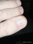 Меланома или невус ногтя фото 2