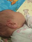 Шишка у новорожденного ребенка фото 2