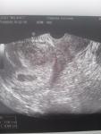 На УЗИ нет эмбриона фото 2