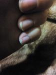 Маленькие волдыри на подушечках пальцев и под ногтем фото 2