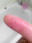 Подкожные пузырьки на указательном пальце фото 5