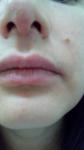 Сыпь в области губ и носа фото 1