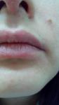 Сыпь в области губ и носа фото 2