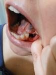 Гранулема зуба 6ка боли в десне и кровь после удаления фото 1