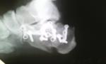 Перелом пяточной кости рентген фото 1