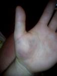 Травма большого пальца руки фото 5