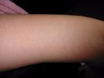 Воспаления на коже рук у ребенка фото 3
