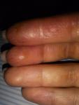 Контактный дерматит кистей рук появляется циклично. Что делать? фото 1