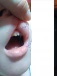 Язврчки с внутренней стороны уголков рта фото 2