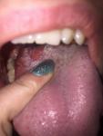 Воспаление сосочков на основании языка в большие бугорки темно-розового цвета фото 1