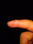 Болячки на душках пальцев рук фото 1