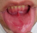 Пятна на нижней губе внутри, красного цвета с белой оконтовкой фото 1