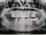 Удаление зуба фото 1