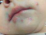 Гнойные высыпания во рту и вокруг рта у ребенка 1 года фото 1
