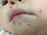 Гнойные высыпания во рту и вокруг рта у ребенка 1 года фото 2