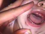 Гнойные высыпания во рту и вокруг рта у ребенка 1 года фото 3