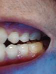 Стирание эмали у корня зуба фото 1