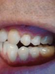 Стирание эмали у корня зуба фото 2