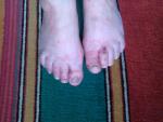 Проблемы с ногтями и пальцами на ногах фото 1