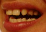 Большое расстояние между передними зубами, что делать? фото 2
