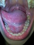 Воспаления на языке и горле фото 2