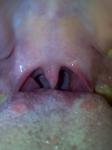 Воспаления на языке и горле фото 1