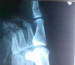 Гипс при переломе большого пальца ноги фото 1